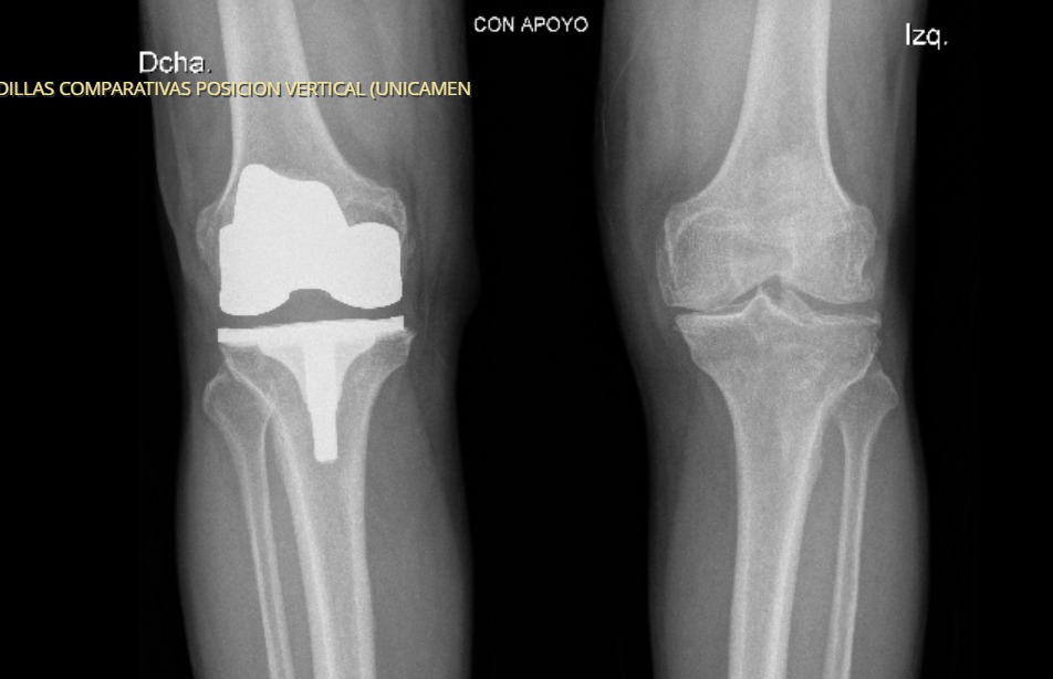 Atención especializada de rodilla en Quirófanos Llanogrande